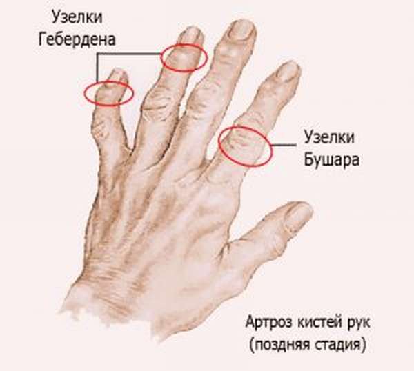 Изменения в суставах пальцев рук